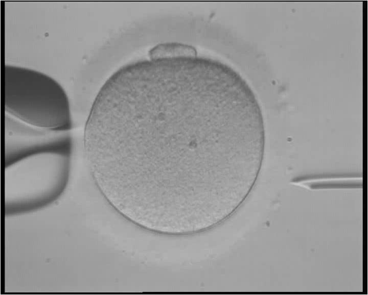 in_vitro_fertilization